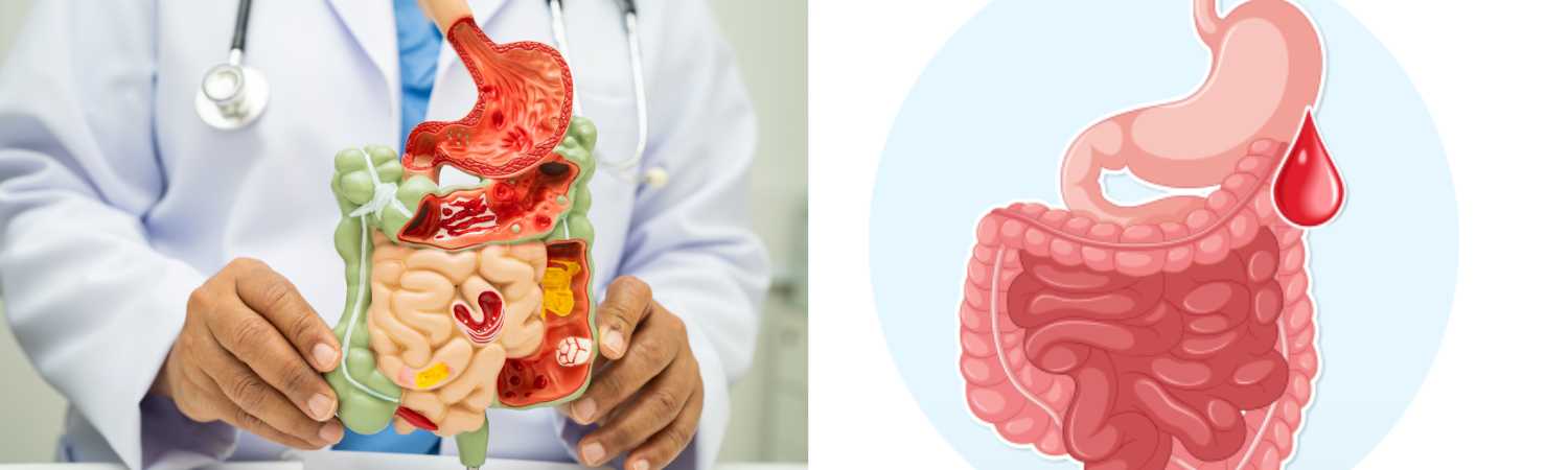 médico experto en gastroenterología cerca de mí para sangrado gastrointestinal