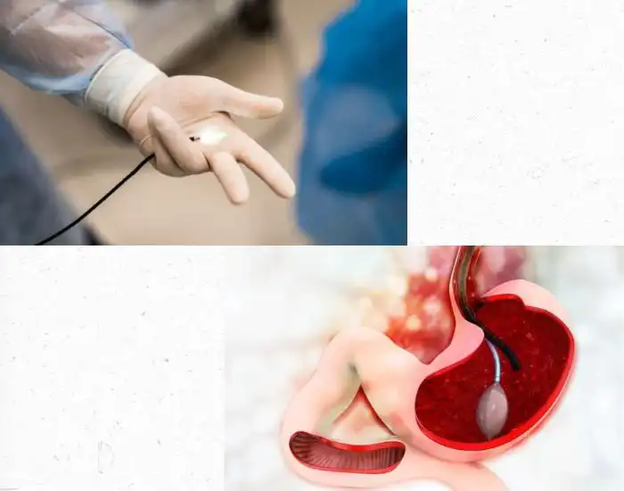 Esophagogastroduodenoscopy (EGD) Houston