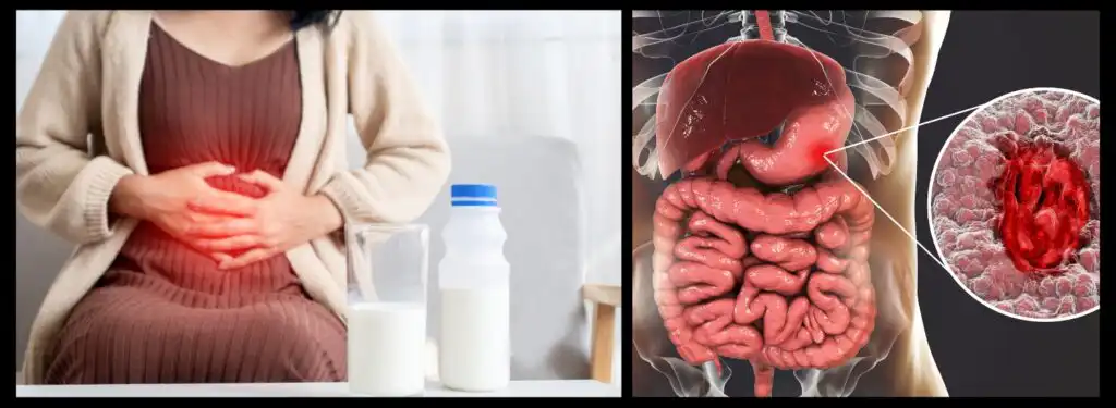 Stomach Inflammation (Gastritis)