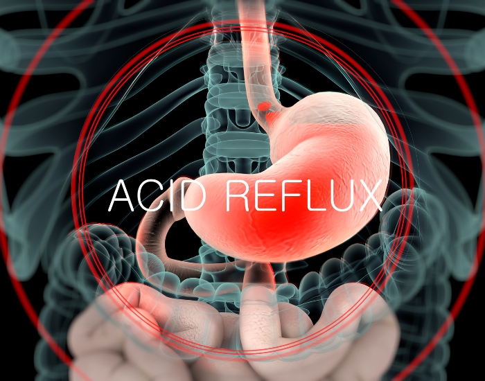 What Acid Reflux Causes | Symptoms, Triggers & Digestive Effects