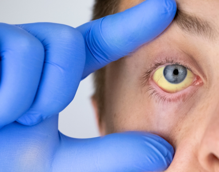 Yellow Eyes Liver Disease – When to See a Doctor in Houston
